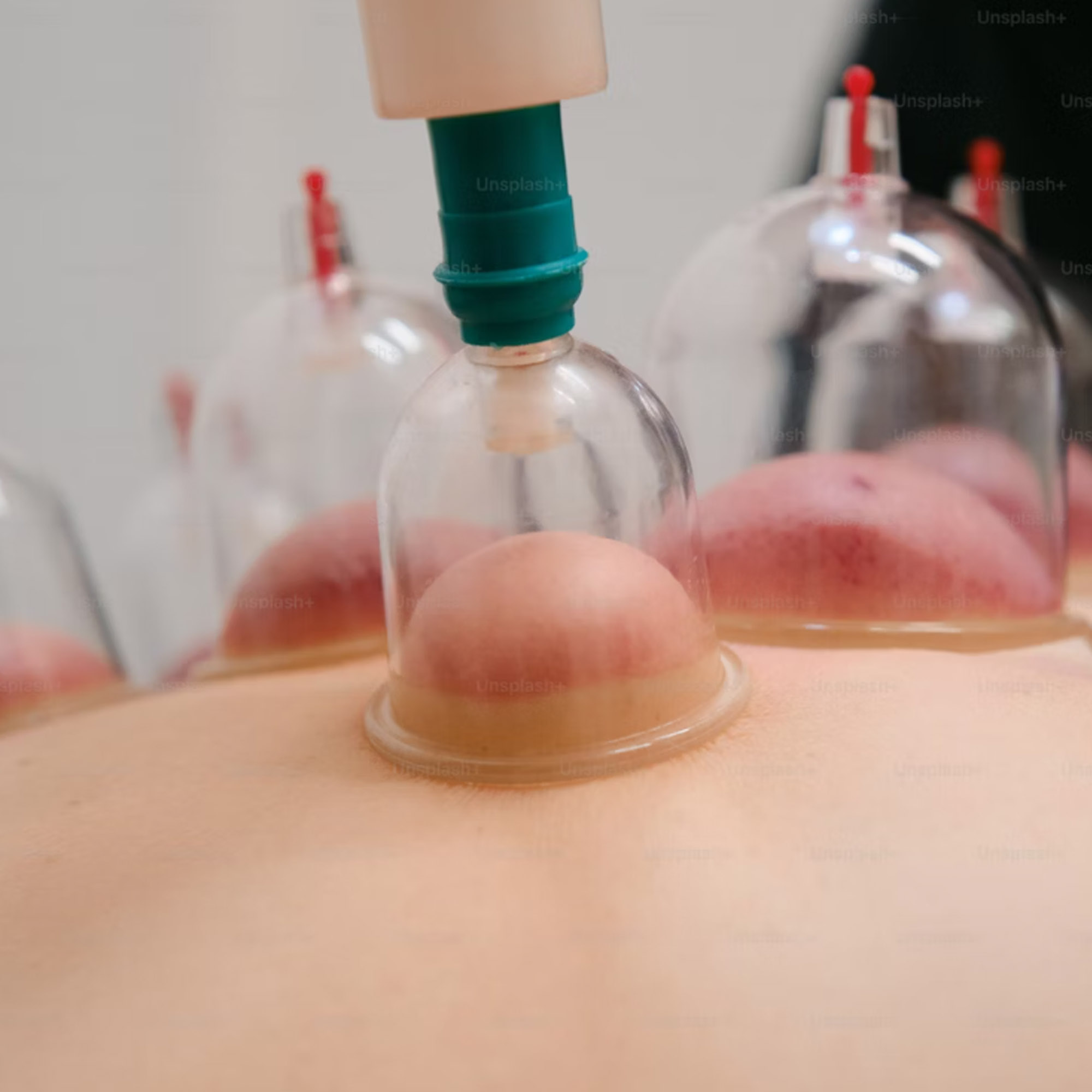 Cupping Therapy