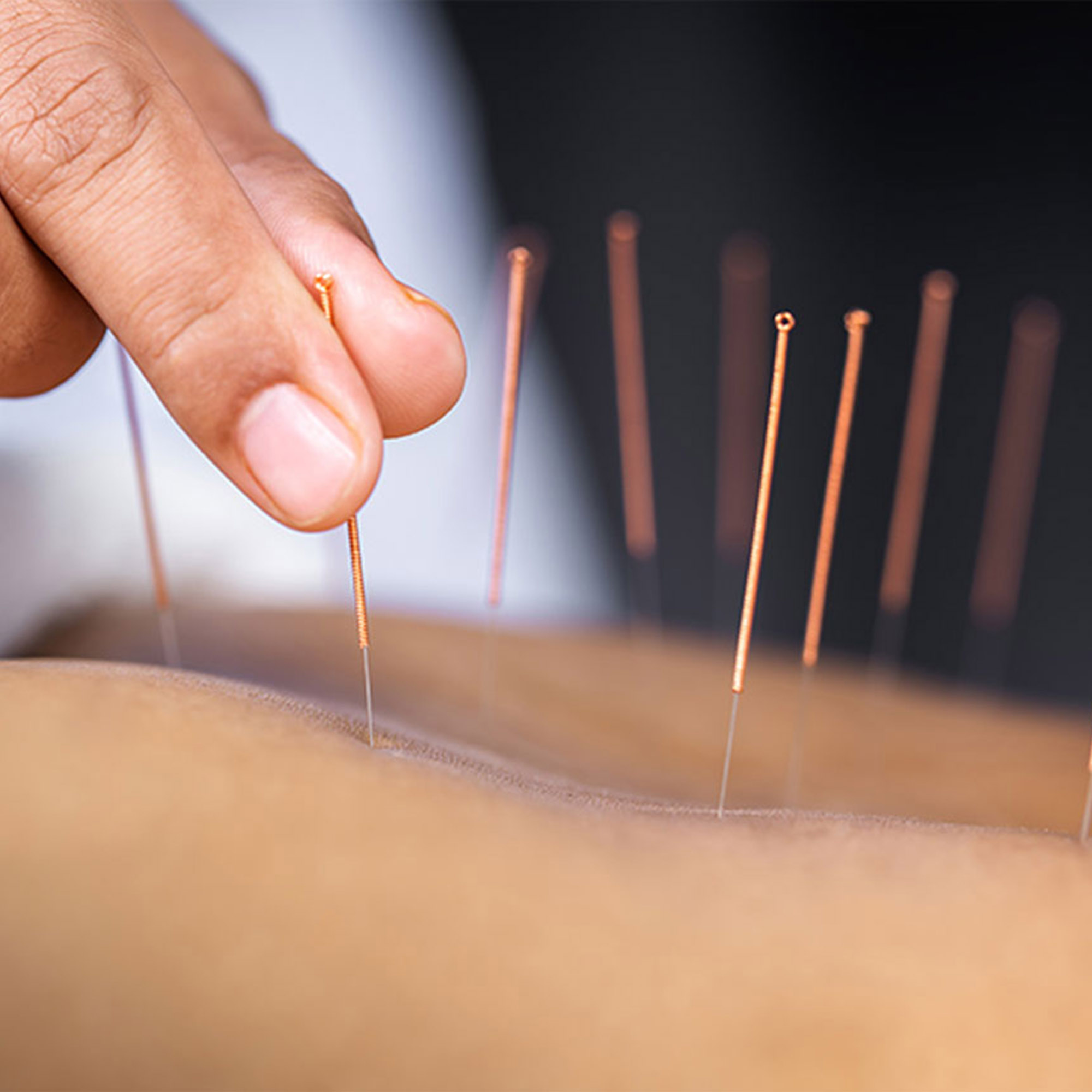 Acupuncture Therapy